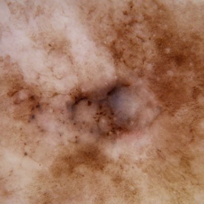 Melanoma on severely sun-damaged skin